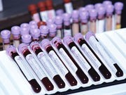Blood Test Might Someday Predict Your Stroke Risk
