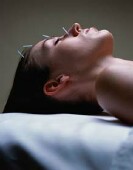 Acupuncture Best for Hot Flashes in Breast Cancer Survivors: Study