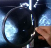 Scientists Probe Obesity's Ties to Breast Cancer Risk