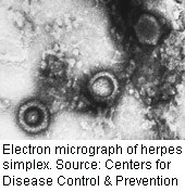 Experimental Gel Could Prevent Genital Herpes Infection
