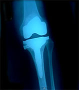 Knee, Hip Replacement Surgeries Linked to Heart Risks