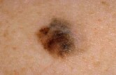 Scientists Spot What Keeps Moles From Becoming Melanomas