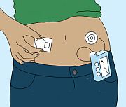 Artificial Pancreas Works Well in Home Trial