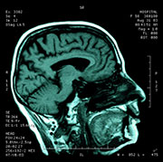 Hi-Tech Scans Spot Brain Damage in High Blood Pressure Patients