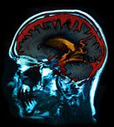 Childhood Brain Tumor Survivors May Have Memory Troubles