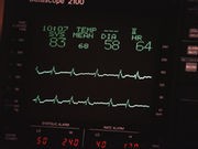 High 'Resting' Heart Rate Tied to Higher Odds of Early Death