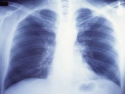 Shorter People Less Likely to Get Lung Transplants
