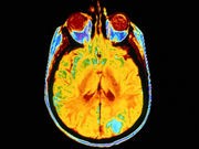 Alzheimer's-Linked Brain Plaques May Also Slow Blood Flow