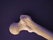 Serious Illness Affects Bone Health