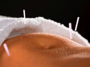 Sham Acupuncture Equals Real Acupuncture for Hot Flashes: Study