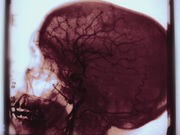Could a Clot-Busting Drug Help Treat a 'Bleeding' Stroke?