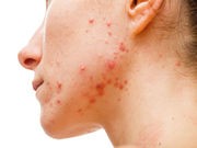 Double Up on Acne Treatments, New Guidelines Say
