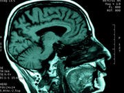 Head Injuries Tied to Buildup of Alzheimer's Plaques, Small Study Finds