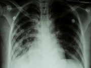 TB Cases Falling for Foreign-Born People in U.S.