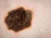 Study Questions Link Between Multiple Moles, Risk for Melanoma
