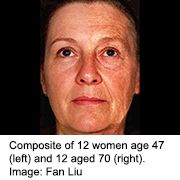 'Freckle' Gene Might Make You Look Older