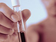 Ridding U.S. of Hepatitis B, C as 'Public Health Problem' Possible: Experts