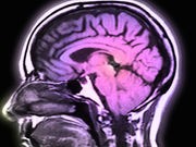 Scans Spot Brain Region That Misfires in Depressed People