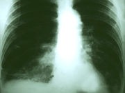 Do Too Many Lung Cancer Patients Miss Out on Surgery?