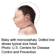 Zika Brain Damage May Occur in Babies With Normal-Sized Heads