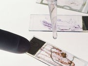 'Liquid Biopsy' May Show Whether Cancer Drugs Are Working
