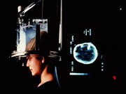 Study of Teen Brains Offers Clues to Timing of Mental Illness