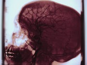 Health Before a Stroke Is Big Predictor of Second Attack