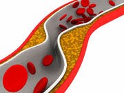 Mouse Study Suggests Stem Cells May Reverse Stroke Damage