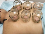 Does 'Cupping' = Success for Olympic Athletes?