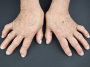 FDA Approves New Biological Drug for Rheumatoid Arthritis