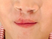 Babies With Cleft Lip Likely to Have Normal Adulthood: Study