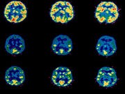 Researchers: We Found Area of Brain That Responds to Placebo