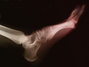 Better Way to Treat Seniors' Ankle Fractures?