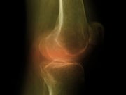 Cartilage From Nose Used to Repair Bum Knees