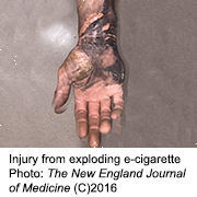 Exploding E-Cigarettes Sending 'Vapers' to Burn Centers