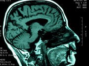 Strokes Decline in Older Americans, Rise in Young
