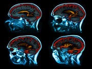 Heart Failure Protein May Signal Early Brain Damage