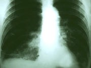 Immune-Focused Drug Shows Promise Against Lung Cancer