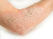 FDA Approves Injectable Psoriasis Drug for Tough Cases