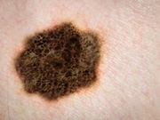 Self-Checks Help Spot Melanoma's Return